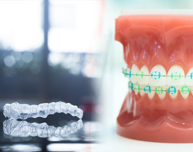 Braces Vs Invisalign- treatment at gardencity  