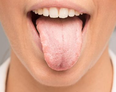 Dry Mouth – Facts and Tips- treatment at gardencity  