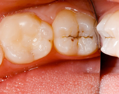 How to Assess Your Risk for Tooth Decay- treatment at gardencity  