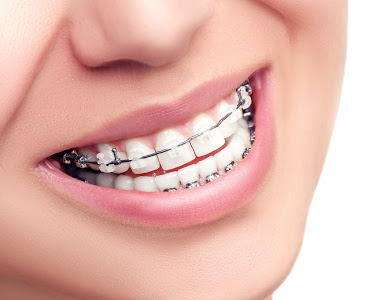 What To Know Before Getting Braces- treatment at gardencity  