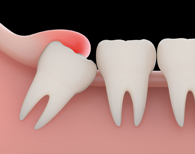 Problems with a Wisdom tooth and when you need to remove them- treatment at gardencity  