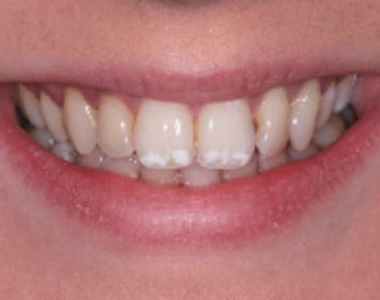 What You Need to Know About Fluorosis- treatment at gardencity  