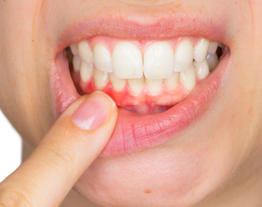 What Causes Receding Gums?- treatment at gardencity  