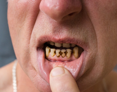 Meth Mouth: How Methamphetamine Use Affects Dental Health- treatment at gardencity  