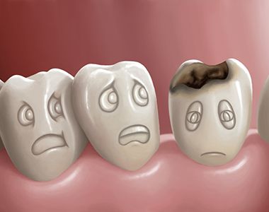 Cavities, or tooth decay- treatment at gardencity  