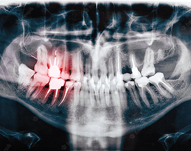 Dental x-ray- treatment at gardencity  