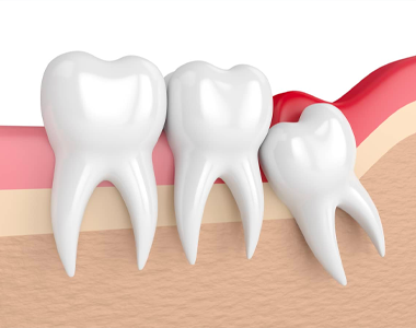 Wisdom Teeth- treatment at gardencity  