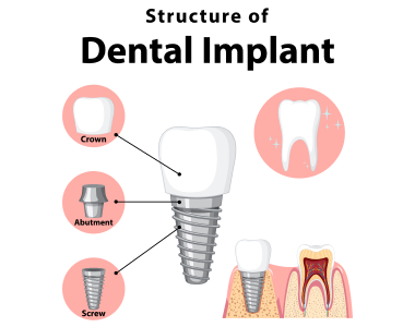 Dental Implants Garden City MI